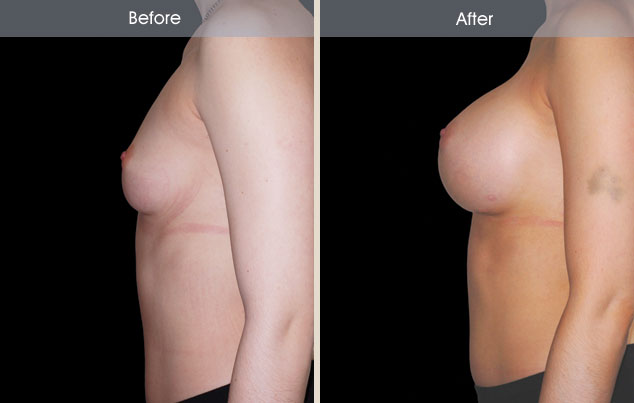 Breast implants before and after