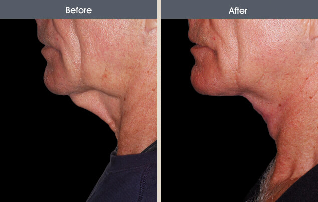 Neck Lift Before and After Photo