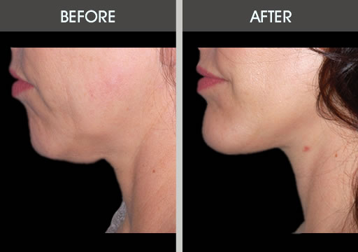 Before and after photo of a woman who had chin implant surgery