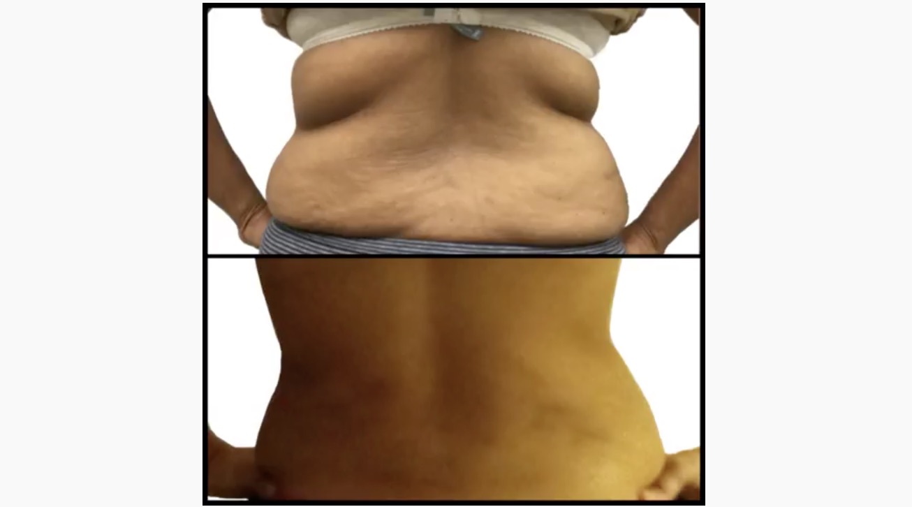 Before and After Liposuction