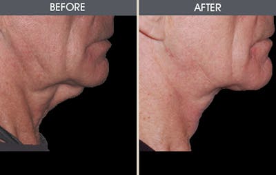 Facelift and Mini Facelift Gallery Before & After Gallery - Patient 2206367 - Image 2