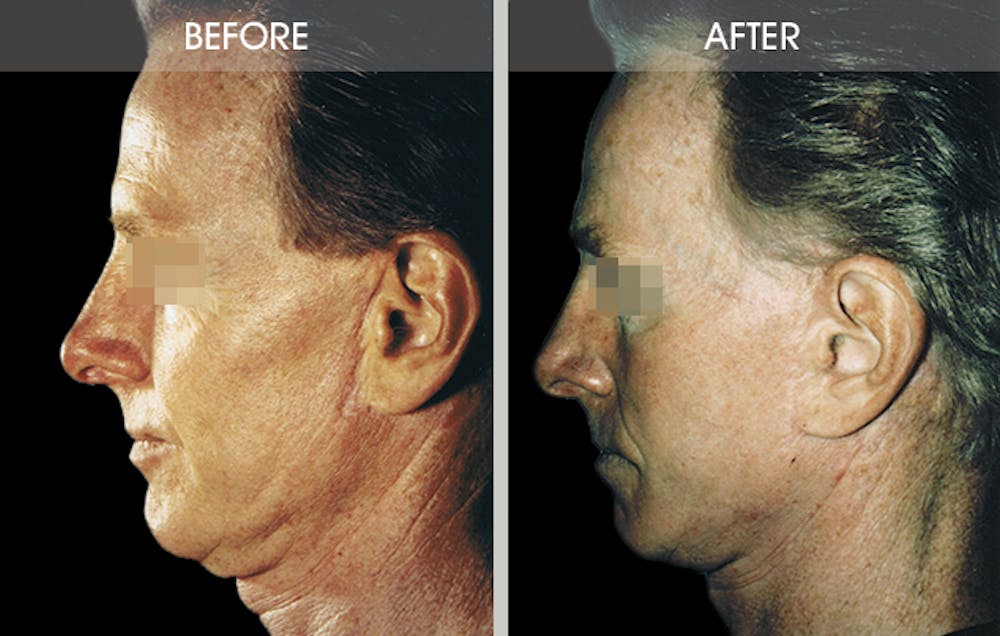 Facelift Before & After Gallery - Patient 2206447 - Image 2