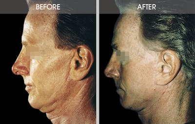 Facelift and Mini Facelift Before & After Gallery - Patient 2206447 - Image 2
