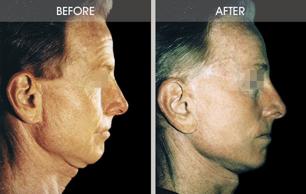 Facelift Before & After Gallery - Patient 2206447 - Image 3