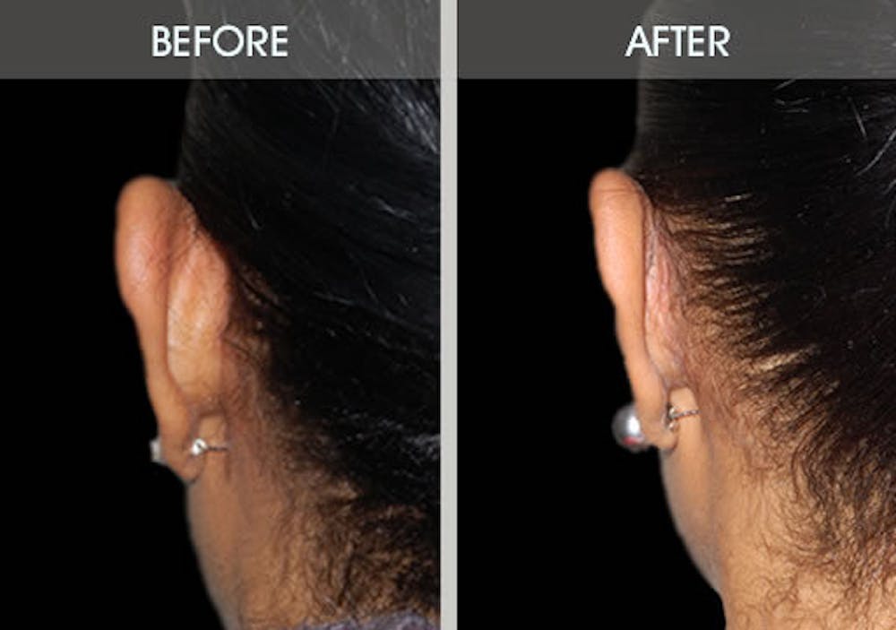Ear Surgery Gallery Before & After Gallery - Patient 2206537 - Image 2