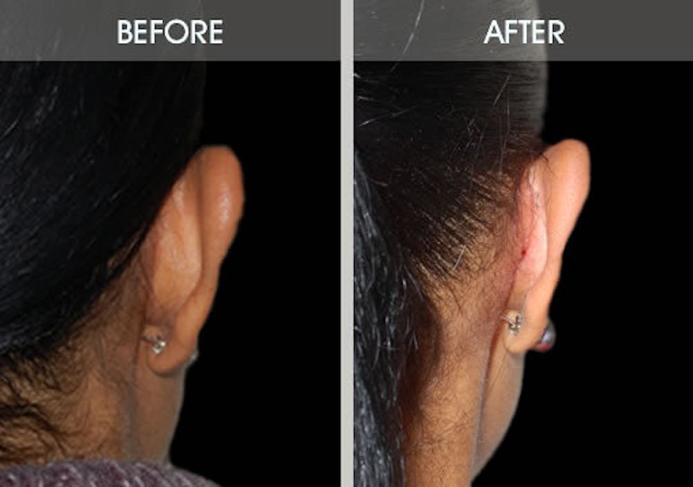 Ear Surgery Gallery Before & After Gallery - Patient 2206537 - Image 3