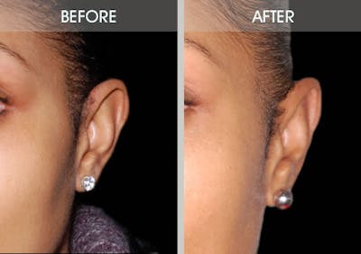 Ear Surgery Gallery Before & After Gallery - Patient 2206537 - Image 4