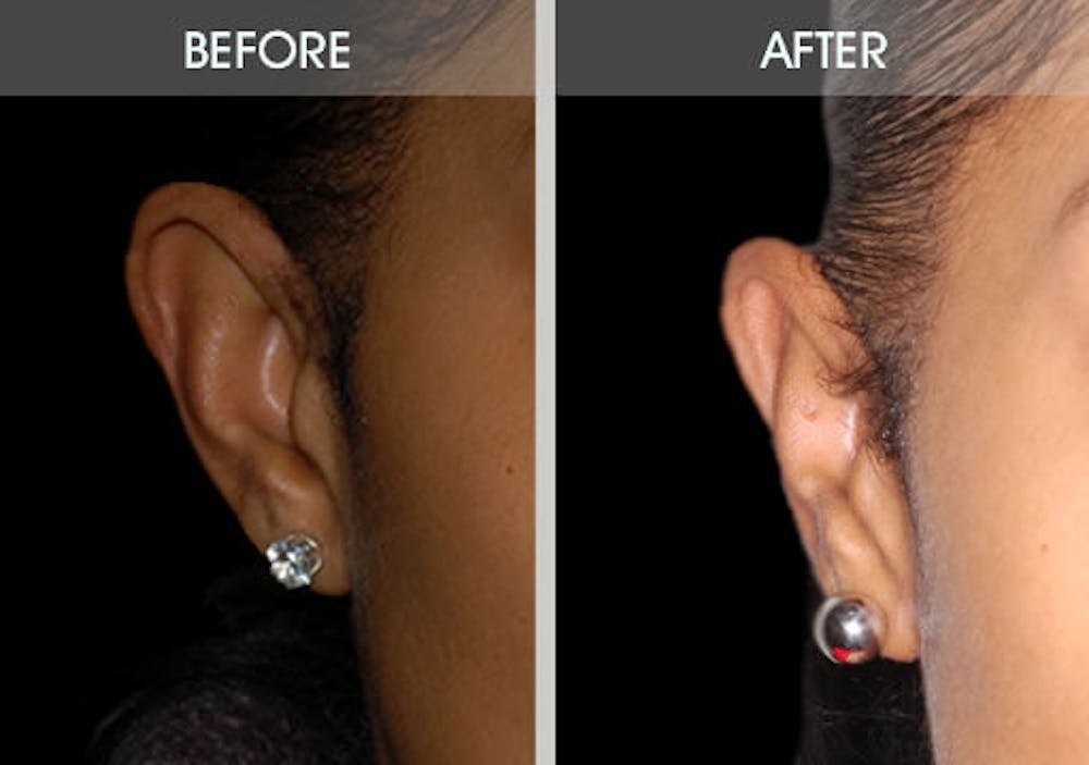 Ear Surgery Gallery Before & After Gallery - Patient 422192 - Image 4