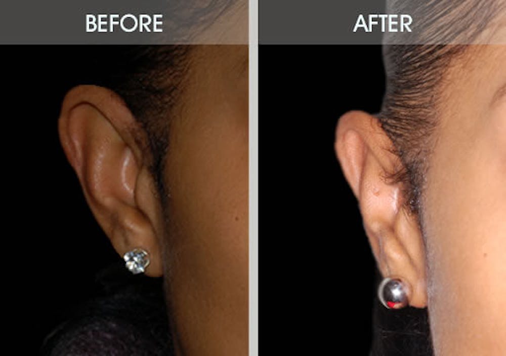 Ear Surgery Gallery Before & After Gallery - Patient 2206537 - Image 5