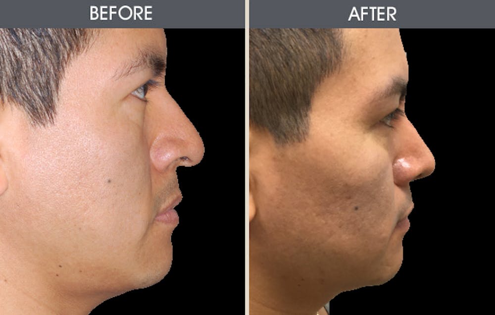 Rhinoplasty Gallery Before & After Gallery - Patient 2206417 - Image 2