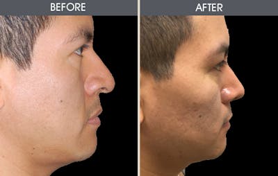 Rhinoplasty Gallery Before & After Gallery - Patient 2206417 - Image 2