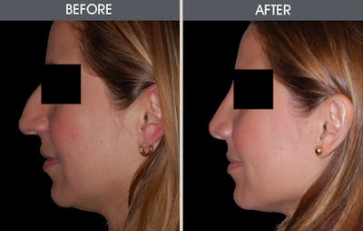 Rhinoplasty Before & After Gallery - Patient 2206458 - Image 2
