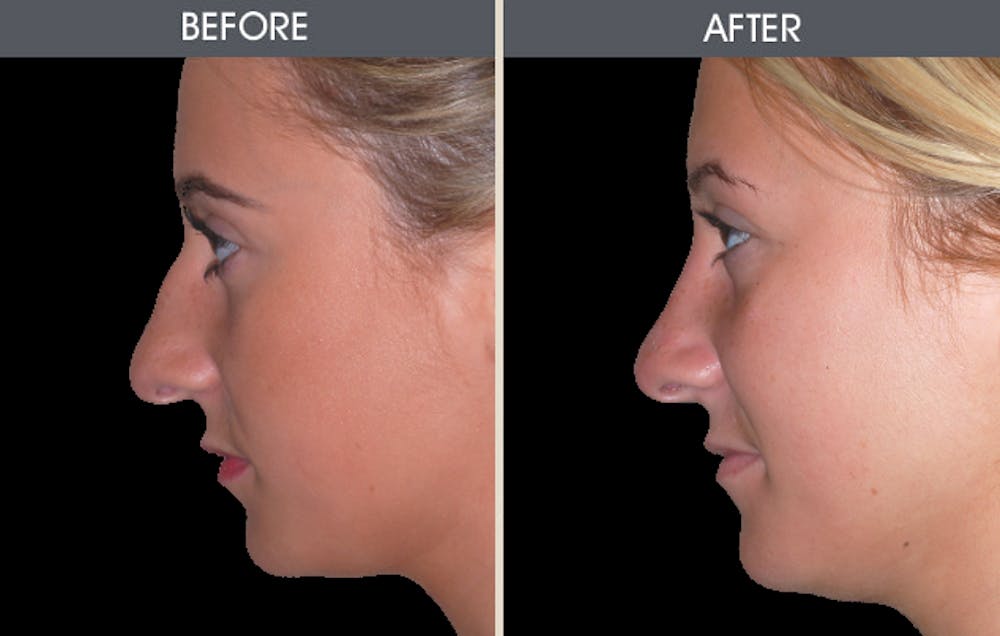 Rhinoplasty Gallery Before & After Gallery - Patient 2206498 - Image 2
