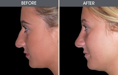 Rhinoplasty Before & After Gallery - Patient 2206498 - Image 2
