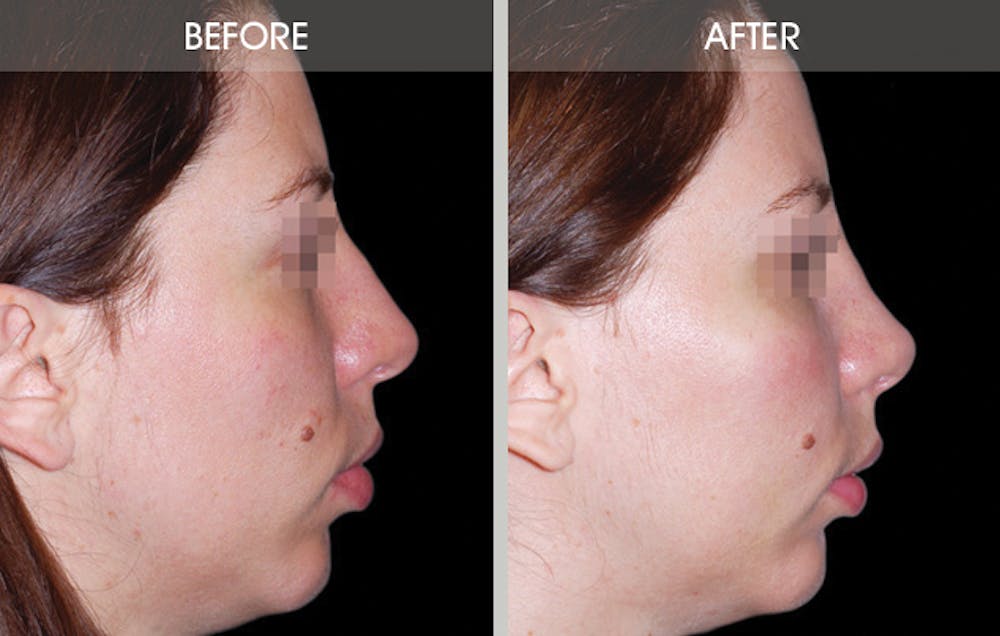 Rhinoplasty Gallery Before & After Gallery - Patient 2206505 - Image 3