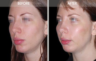 Rhinoplasty Gallery Before & After Gallery - Patient 2206505 - Image 2