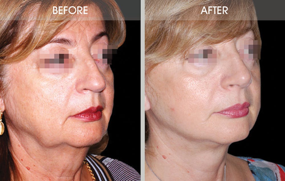 Rhinoplasty Gallery Before & After Gallery - Patient 2206539 - Image 2