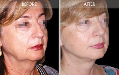 Rhinoplasty Gallery Before & After Gallery - Patient 2206539 - Image 2