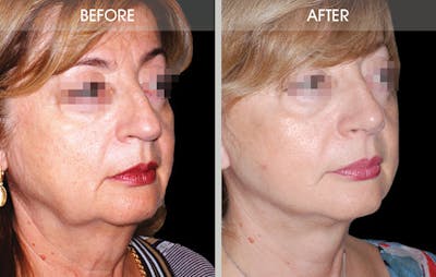 Rhinoplasty Before & After Gallery - Patient 2206539 - Image 2
