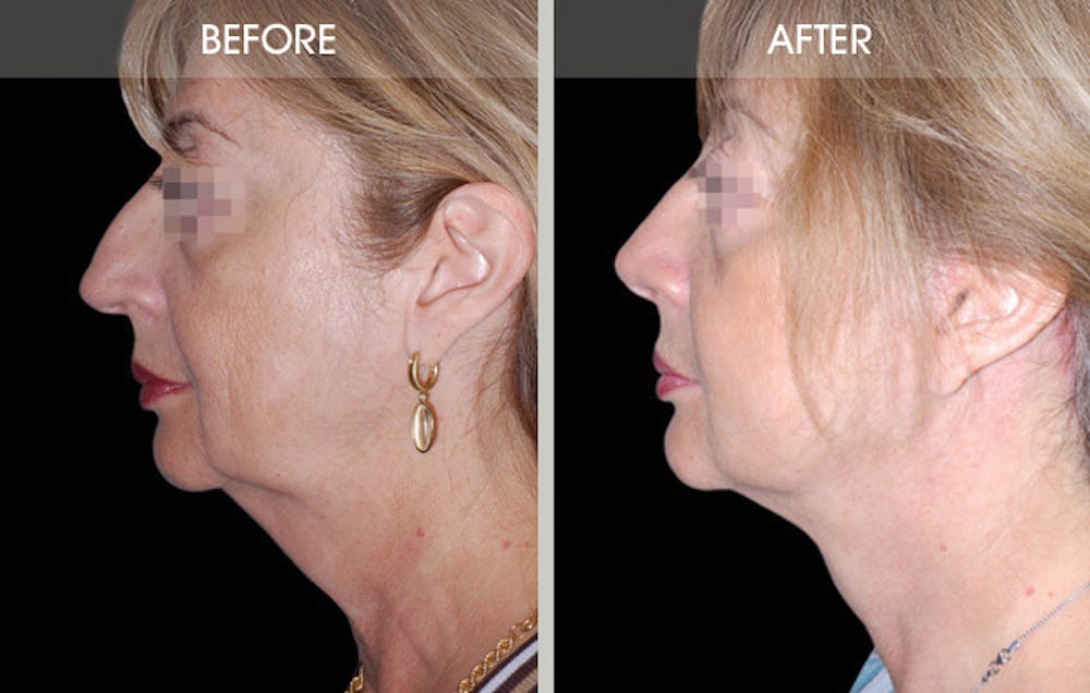Rhinoplasty Gallery Before & After Gallery - Patient 2206539 - Image 3