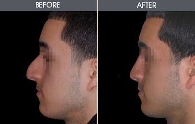 Rhinoplasty Gallery Before & After Gallery - Patient 2206571 - Image 2