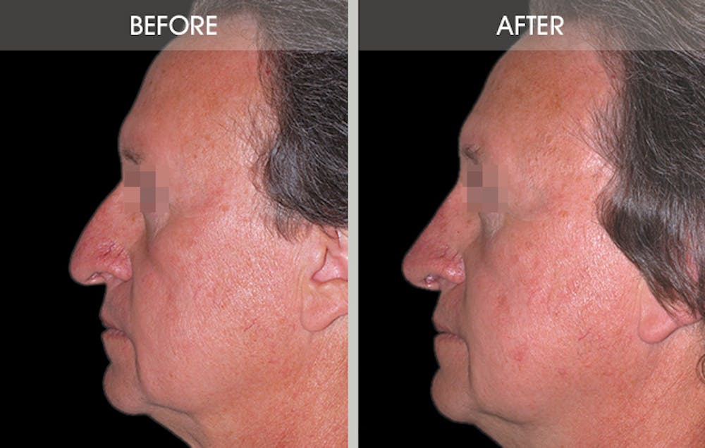 Rhinoplasty Gallery Before & After Gallery - Patient 2206589 - Image 2