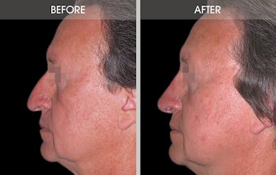 Rhinoplasty Before & After Gallery - Patient 2206589 - Image 2