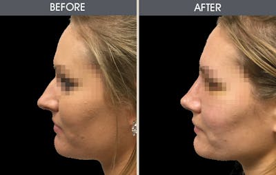Rhinoplasty Before & After Gallery - Patient 2206627 - Image 2