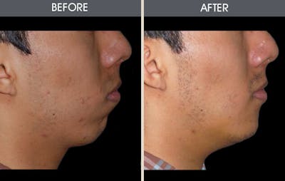 Chin Implants Gallery Before & After Gallery - Patient 2206752 - Image 2