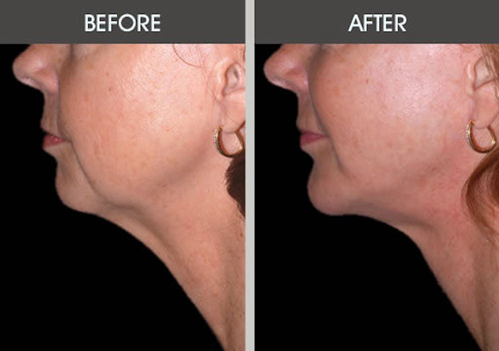 Chin Implants Before & After Gallery - Patient 2206771 - Image 2