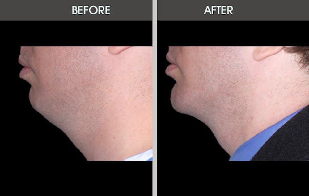 Chin Implants Before & After Gallery - Patient 2206773 - Image 2