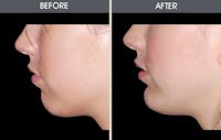 Chin Implants Gallery Before & After Gallery - Patient 2206820 - Image 1
