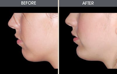 Chin Implants Gallery Before & After Gallery - Patient 2206820 - Image 1