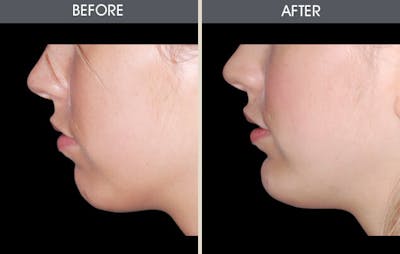 Chin Implants Before & After Gallery - Patient 2206820 - Image 2