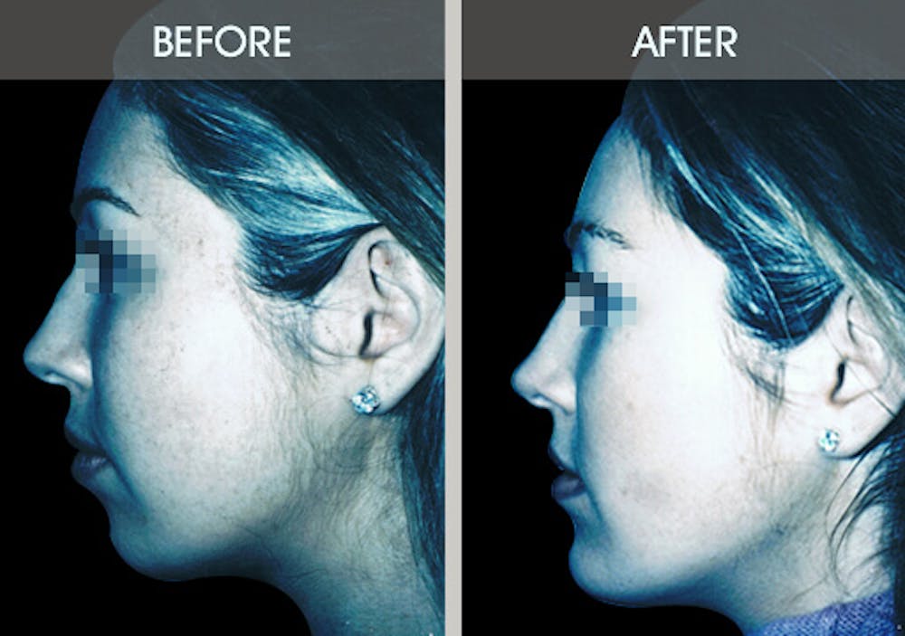 Buccal Fat Removal Before & After Gallery - Patient 2207141 - Image 2