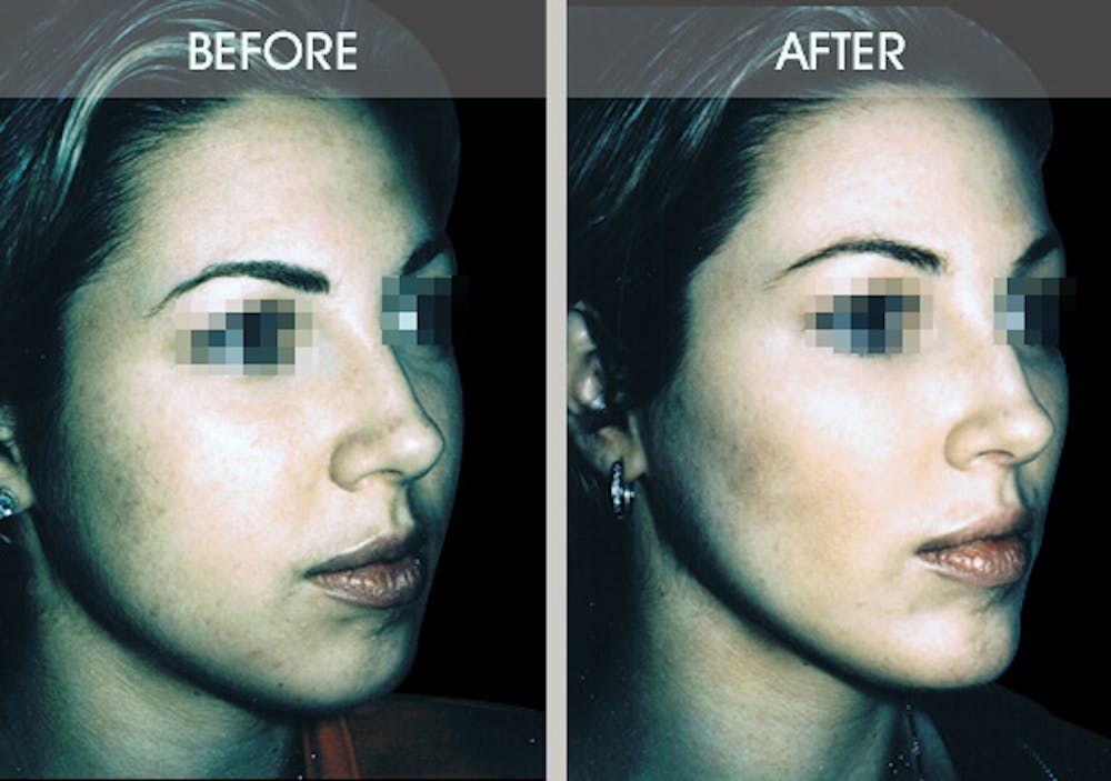 Buccal Fat Removal Gallery Before & After Gallery - Patient 2207141 - Image 3