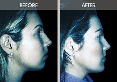 Buccal Fat Removal Gallery Before & After Gallery - Patient 2207141 - Image 4