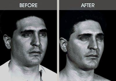 Buccal Fat Removal Before & After Gallery - Patient 2207142 - Image 2