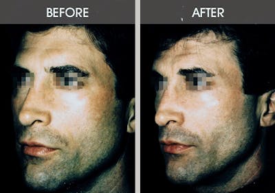 Buccal Fat Removal Gallery Before & After Gallery - Patient 2207145 - Image 2