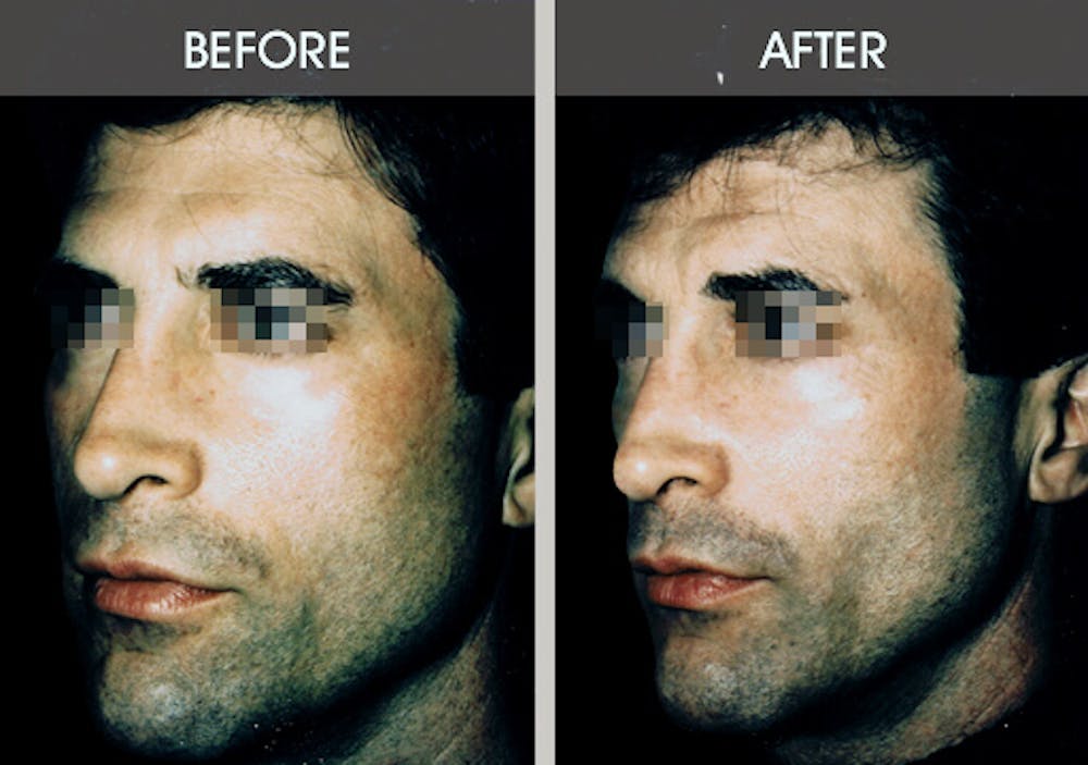 Buccal Fat Removal Before & After Gallery - Patient 2207145 - Image 2