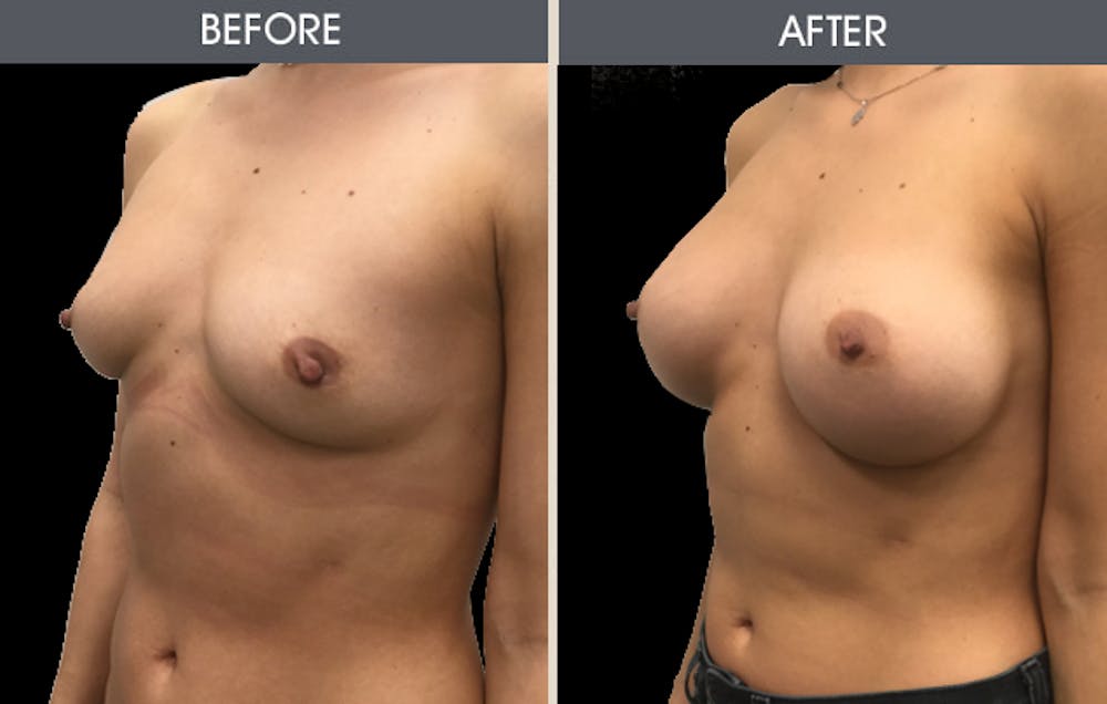Breast Augmentation Gallery Before & After Gallery - Patient 2207153 - Image 2
