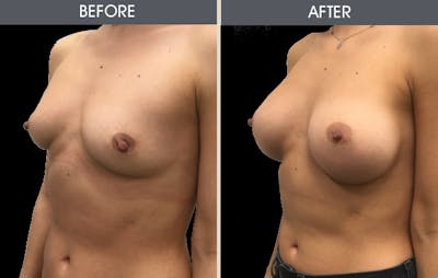 Breast Augmentation Before & After Gallery - Patient 2207153 - Image 2