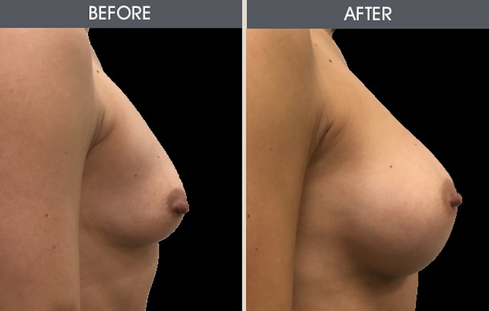 Breast Augmentation Gallery Before & After Gallery - Patient 2207153 - Image 3