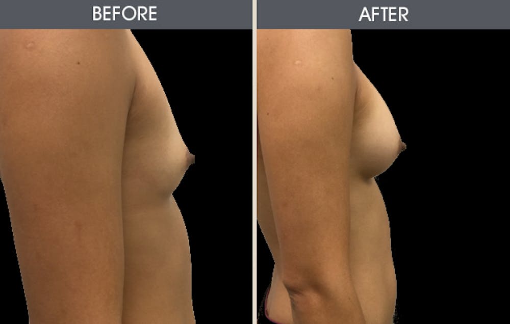 Breast Augmentation Before & After Gallery - Patient 2207154 - Image 2