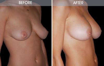 Breast Augmentation Before & After Gallery - Patient 2207156 - Image 2
