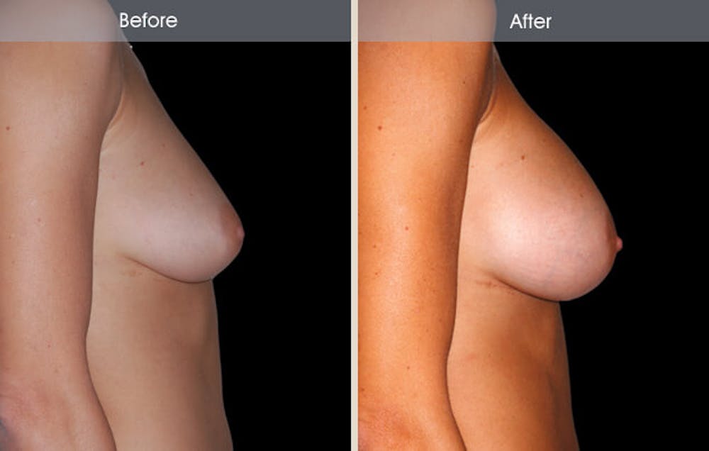 Breast Augmentation Gallery Before & After Gallery - Patient 2207156 - Image 3