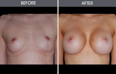Breast Augmentation Before & After Gallery - Patient 2207157 - Image 2
