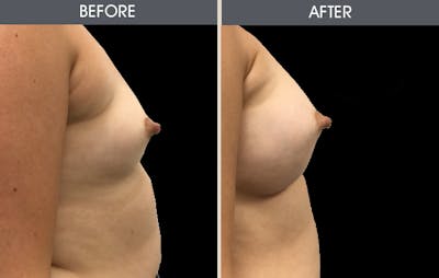 Breast Augmentation Gallery Before & After Gallery - Patient 2207162 - Image 2