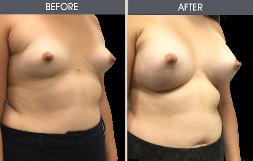 Breast Augmentation Gallery Before & After Gallery - Patient 2207162 - Image 3