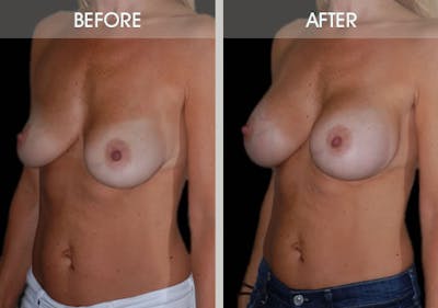 Breast Augmentation Gallery Before & After Gallery - Patient 2207164 - Image 2